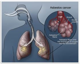 Asbestos Mesothelioma Cancer Chart